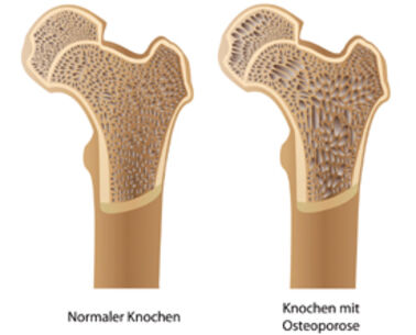 Diagnose Osteoporose