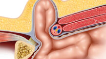 Was Sie über Hernien wissen sollten